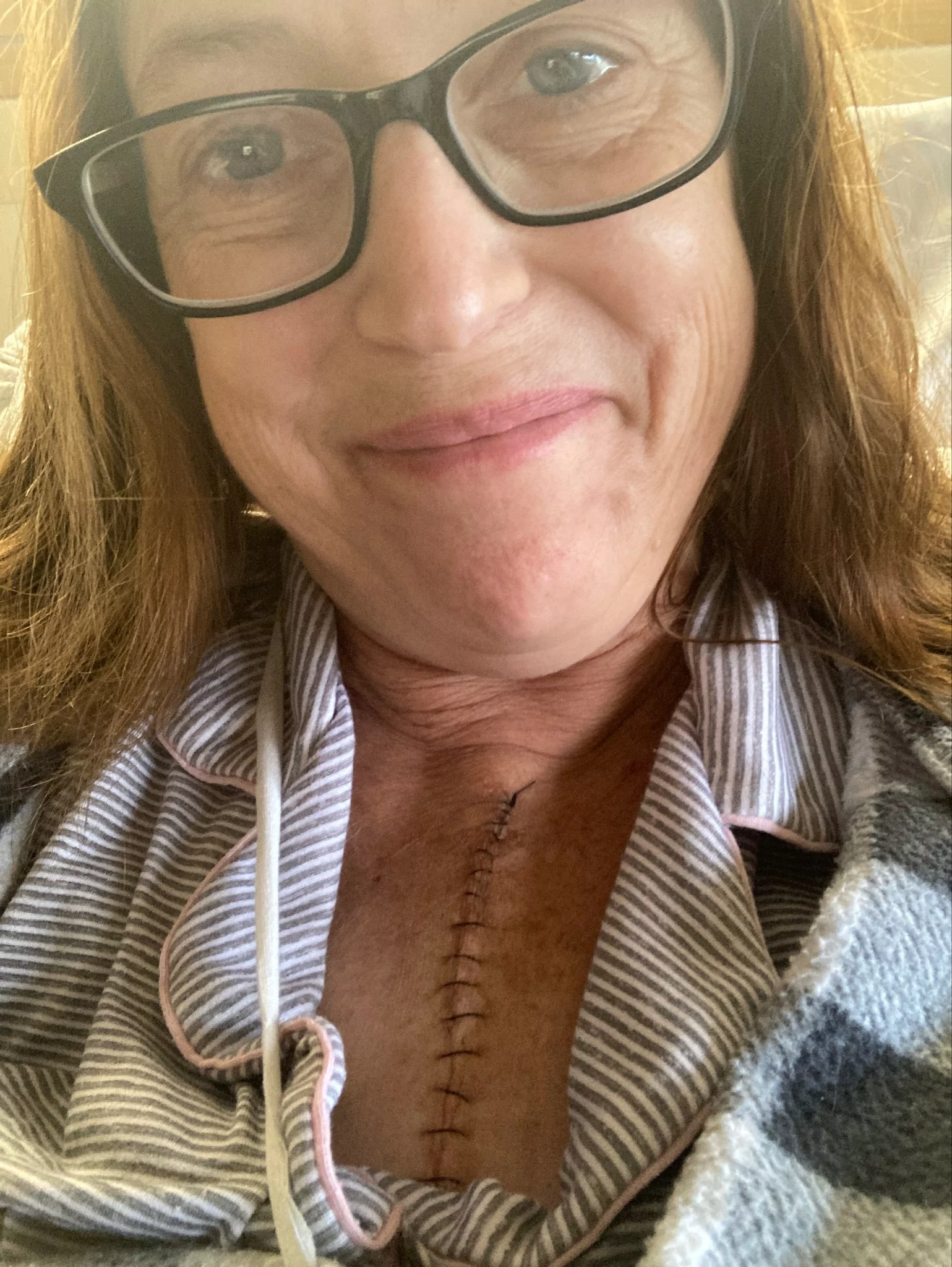 Sherry Johnson shows the stitches on her chest after her second heart (and kidney) transplant at Michigan Medicine.