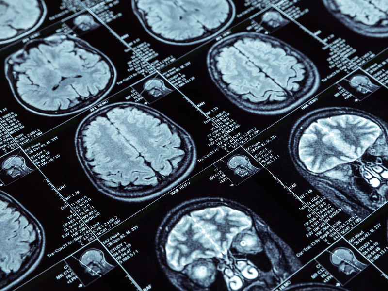 X-ray images of brains