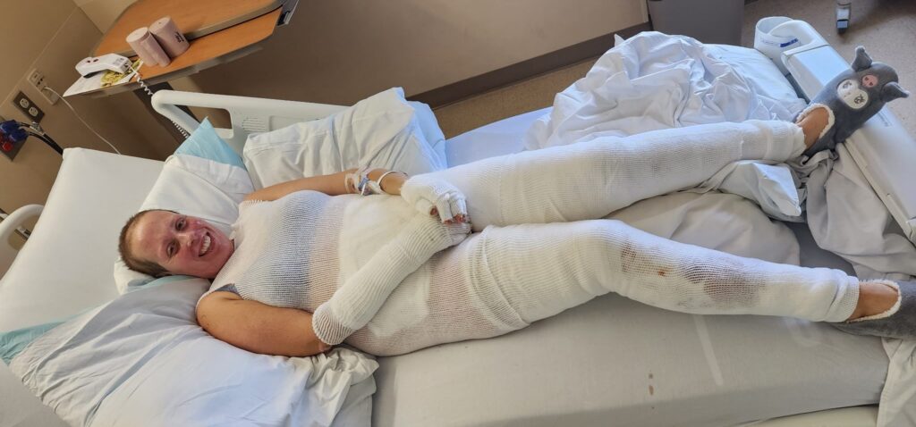 Jen Bennett had severe burns from her face to her shins after a fire pit accident.